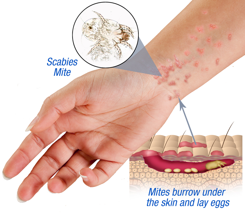 Scabies  The London Skin And Hair Clinic